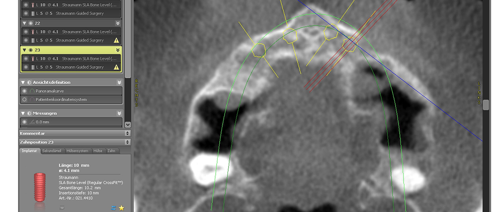 Am Computer können virtuelle Implantate positioniert und ausgerichtet werden. Die optimale Länge und der richtige Implantatdurchmesser lassen sich bestimmen.